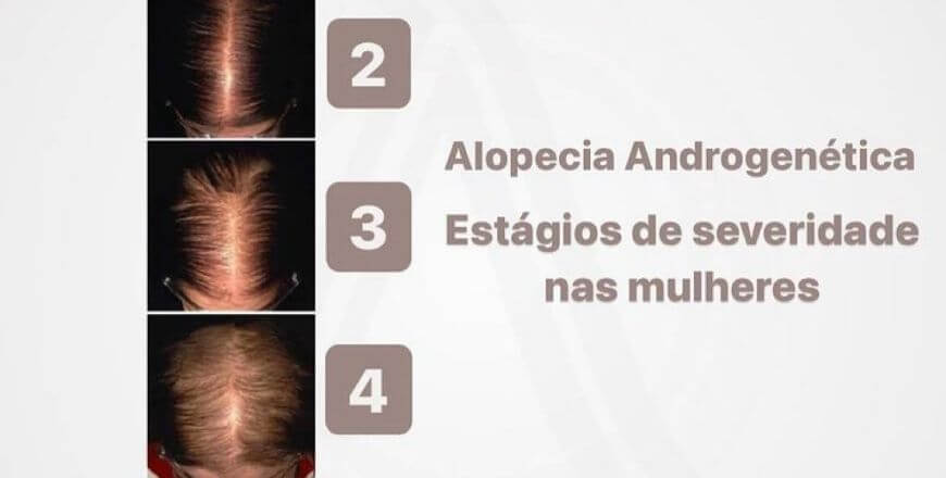 Estágio 4 Cabelo Vermelho